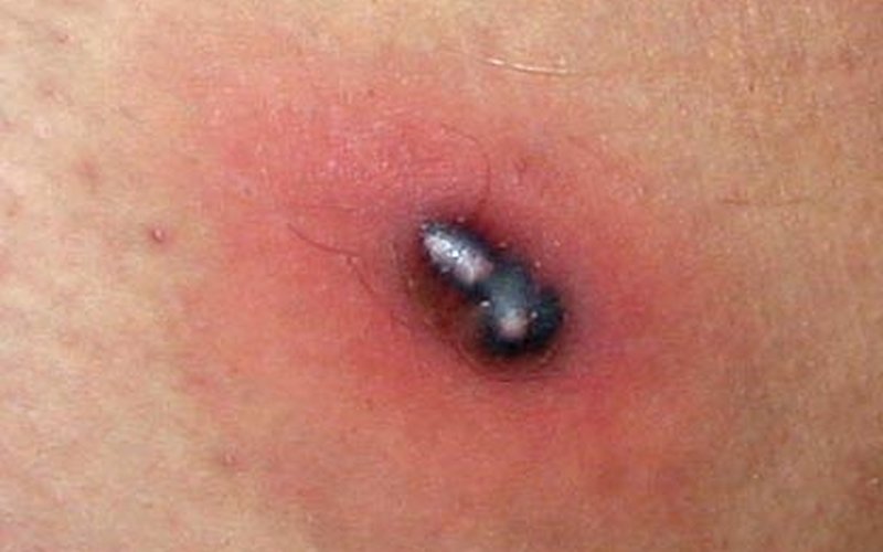 Абсцесс мозга из-за амёбы Naegleria fowleri развивается за 3-7 дней и убивает 95% заражённых через п